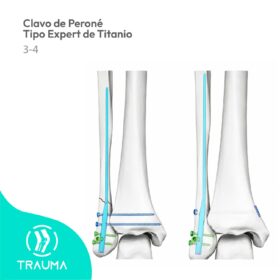 Clavo de Peroné Tipo Expert de Titanio