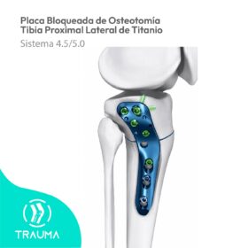 Placa Bloqueada de Osteotomía Tibia Proximal Lateral de Titanio