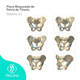 Placa Bloqueada de Pelvis de Titanio